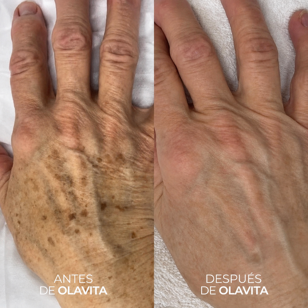 Antes y después - manos